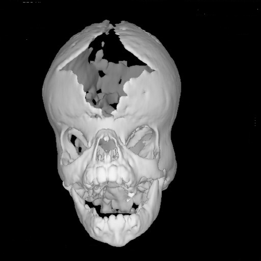 CRANIOSTENOSI