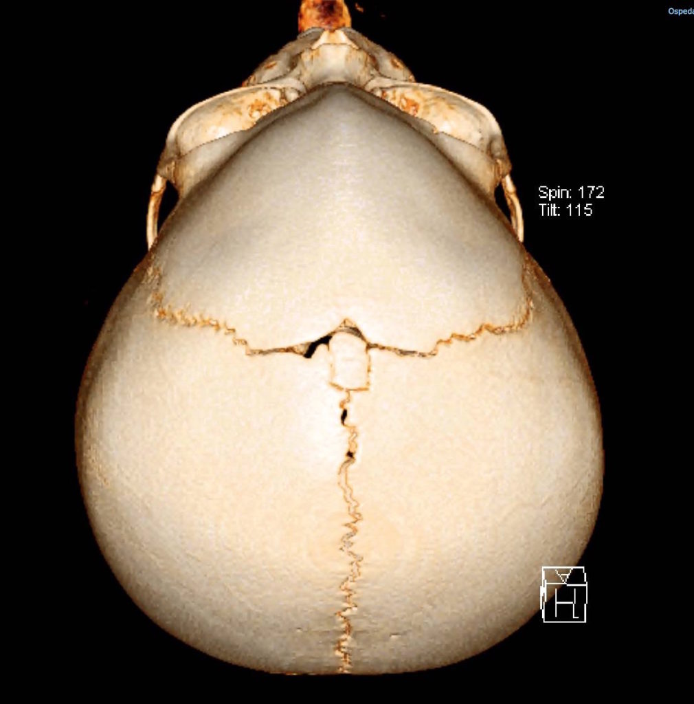 TRIGONOCEFALIA